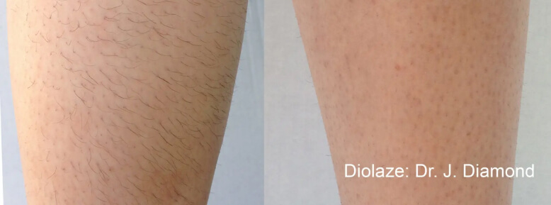diolaze-results-2