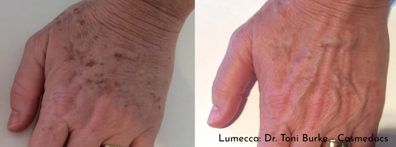 lumecca-results-3